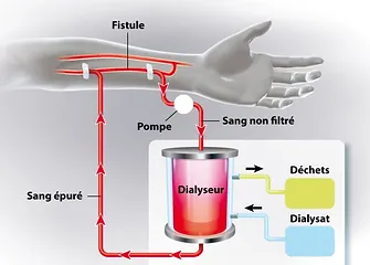 aidir-association-dialise-abidjan'cote-d-ivoire-cnptir-prevention-dialyse-insuffisance-rénale