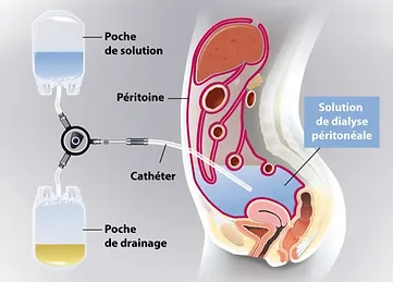 aidir-association-dialise-abidjan'cote-d-ivoire-cnptir-prevention-dialyse-insuffisance-rénale